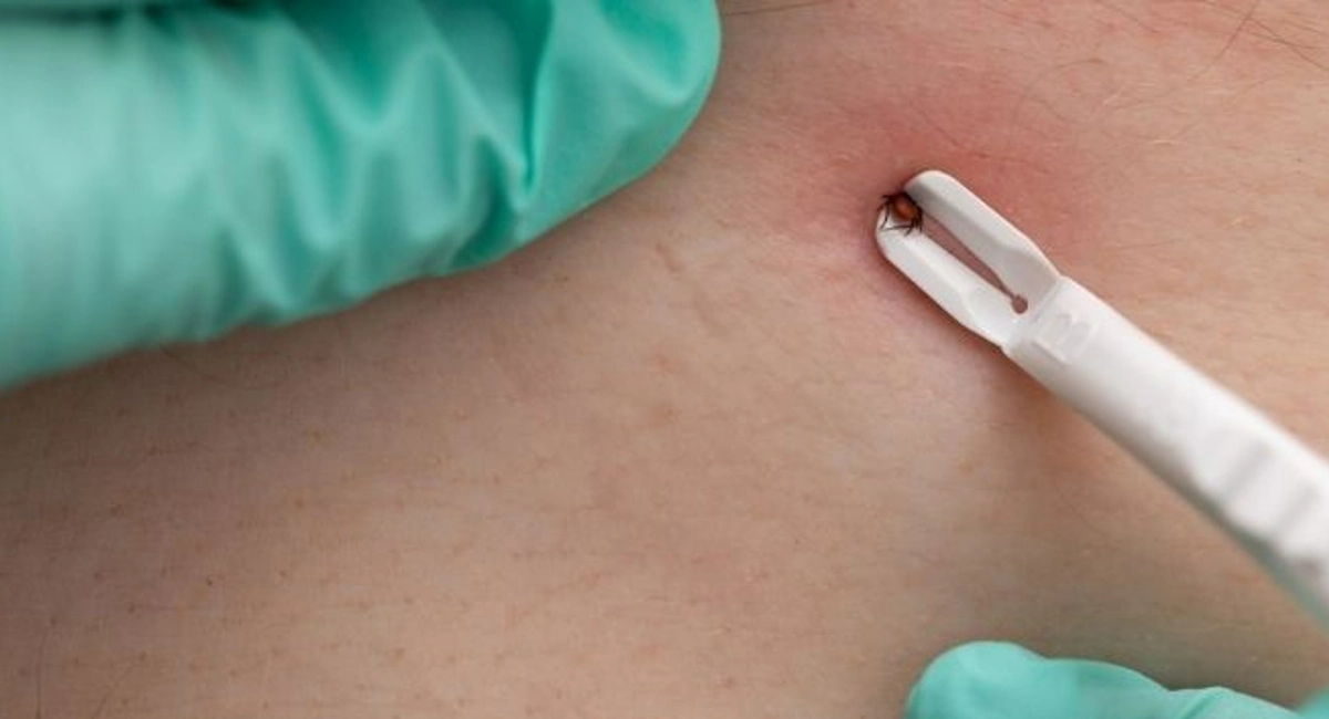A person wearing rubber green medical gloves using tweezers to remove a tick off of a human.