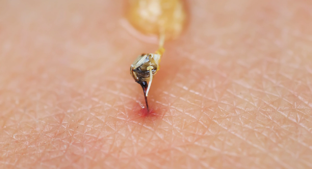 A sharp bee sting with a venom sac attached