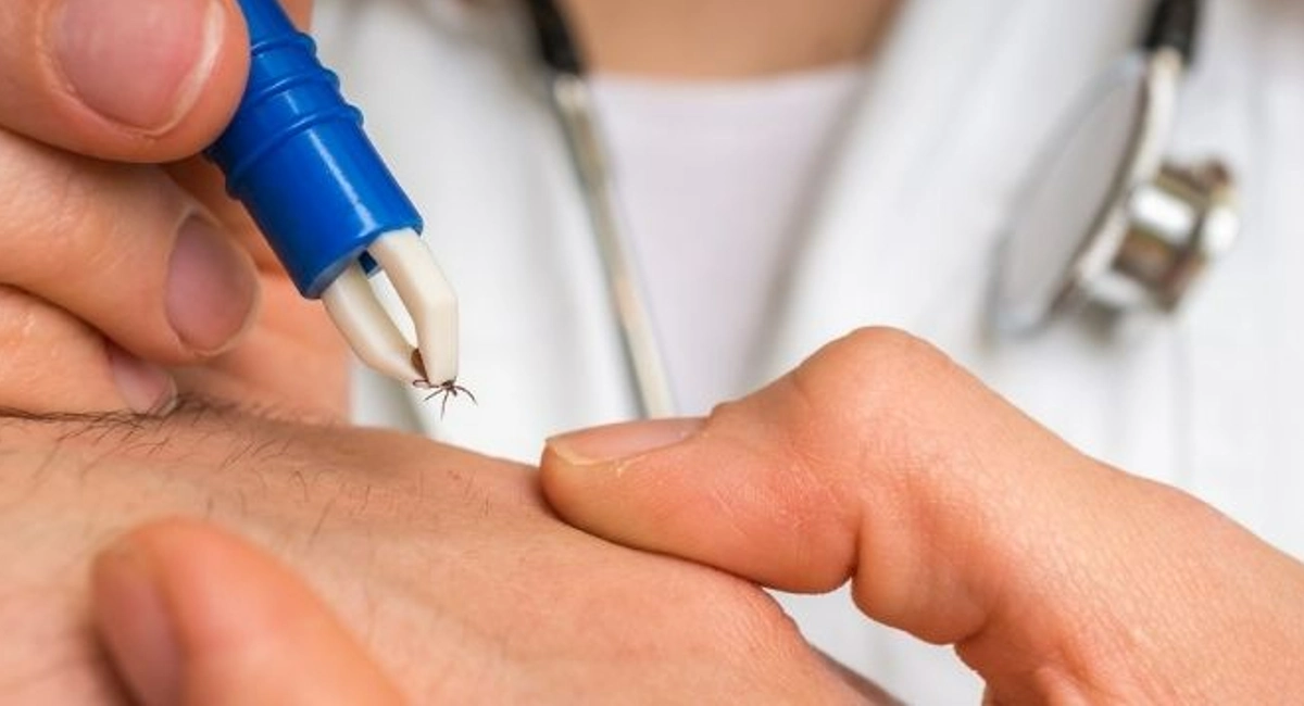 Doctor using blue and white tweezers to remove a tick from a human.